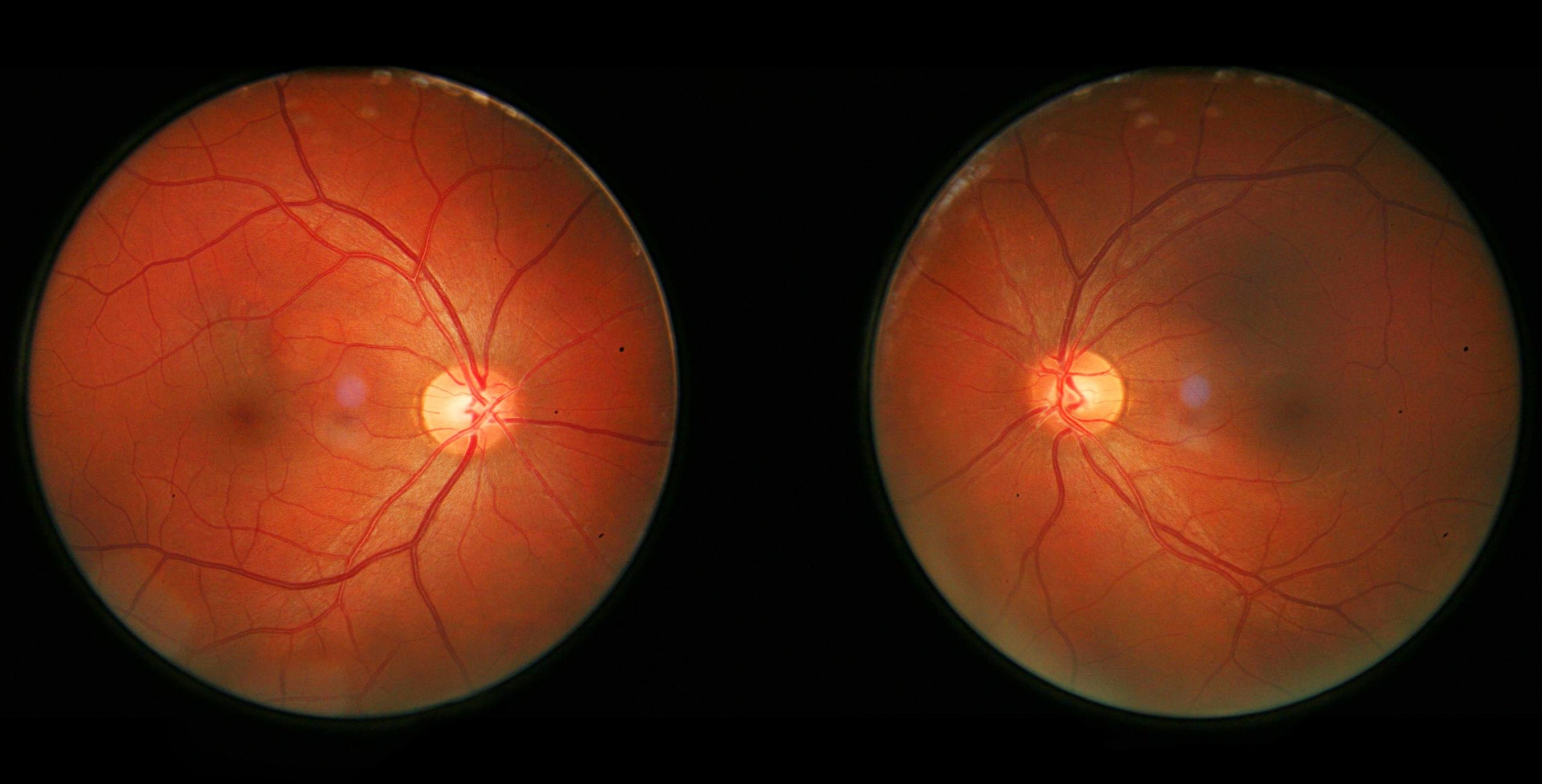 Allies retinal. Крем allies of skin. Периферическая хориоретинальная дистрофия. Allies of skin косметика. Хориоретинальная колобома.